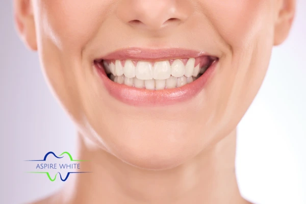 Follow your teeth whitening aftercare Newport to prolong your whiter smile!